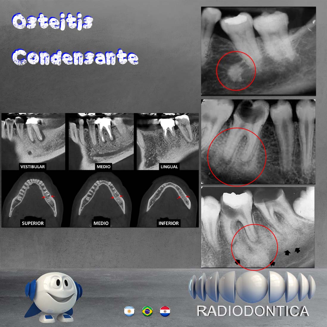 Caso Nº 19 Osteitis vs Osteoesclerosis Radiodontica